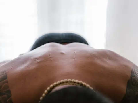 Fine acupuncture needles along the spine of a man lying face down